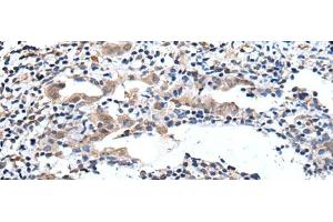 Immunohistochemistry of paraffin-embedded Human cervical cancer tissue using ELMO1 Polyclonal Antibody at dilution of 1:40(x200) (ELMO1 Antikörper)
