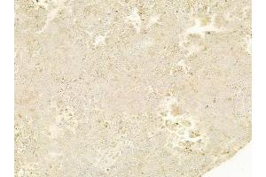 ABIN6263603 and ABIN6278495 at 1/100 staining human melanoma by IHC-P. (Netrin 1 Antikörper  (C-Term))