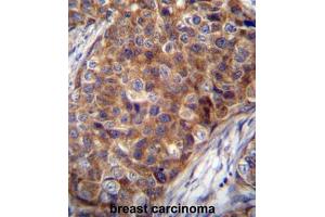 COX7A2L Antibody (Center) immunohistochemistry analysis in formalin fixed and paraffin embedded human breast carcinoma followed by peroxidase conjugation of the secondary antibody and DAB staining.