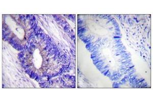 Immunohistochemical analysis of paraffin-embedded human colon carcinoma tissue using PKA α/β CAT (Phospho-Thr197) antibody (left)or the same antibody preincubated with blocking peptide (right). (PRKACA Antikörper  (pThr197))