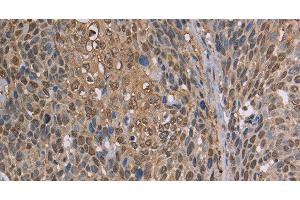 Immunohistochemistry of paraffin-embedded Human cervical cancer using CAB39 Polyclonal Antibody at dilution of 1:50 (CAB39 Antikörper)