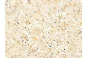 ABIN6261261 and ABIN6276608 at 1/100 staining human astrocytoma by IHC-P.