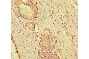 Immunohistochemistry of paraffin-embedded human prostate cancer using ABIN7157298 at dilution of 1:100 (KLHL38 Antikörper  (AA 1-200))