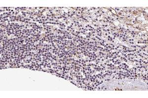ABIN6273085 at 1/100 staining Human lymph cancer tissue by IHC-P. (VNN1 Antikörper)