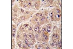 Formalin-fixed and paraffin-embedded human hepatocarcinoma tissue reacted with PIM3 antibody (C-term), which was peroxidase-conjugated to the secondary antibody, followed by DAB staining. (PIM3 Antikörper  (C-Term))