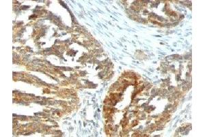 Formalin-fixed, paraffin-embedded human ovarian carcinoma stained with VEGF antibody (VEGF/1063). (VEGFA Antikörper)