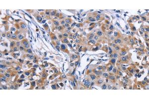 Immunohistochemistry of paraffin-embedded Human lung cancer tissue using MPO Polyclonal Antibody at dilution 1:50 (Myeloperoxidase Antikörper)