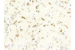 ABIN6264715 and ABIN6279710 at 1/100 staining human melanoma by IHC-P. (RFTN2 Antikörper  (C-Term))