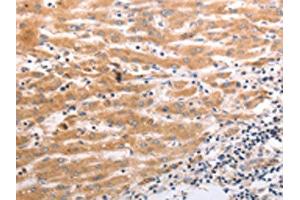 The image on the left is immunohistochemistry of paraffin-embedded Human liver cancer tissue using ABIN7190920(HCRTR1 Antibody) at dilution 1/70, on the right is treated with synthetic peptide. (HCRTR1 Antikörper)