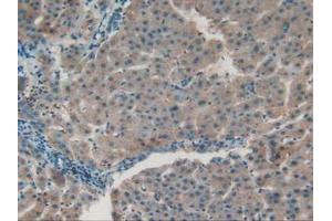 IHC-P analysis of Human Liver Cancer Tissue, with DAB staining.