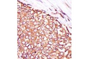 Formalin-fixed and paraffin-embedded human cancer tissue reacted with the primary antibody, which was peroxidase-conjugated to the secondary antibody, followed by DAB staining. (PKC theta Antikörper  (C-Term))