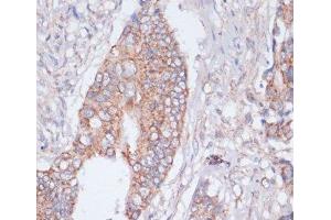 Immunohistochemistry of paraffin-embedded Human colon cancer using MBTPS1 Polyclonal Antibody at dilution of 1:100 (40x lens). (MBTPS1 Antikörper)
