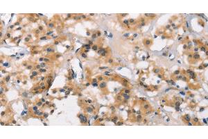 Immunohistochemistry of paraffin-embedded Human thyroid cancer using MARC1 Polyclonal Antibody at dilution of 1:40 (MOSC1 Antikörper)