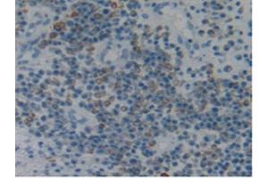 IHC-P analysis of Human Skin Cancer Tissue, with DAB staining. (Fibrillin 1 Antikörper  (AA 723-902))