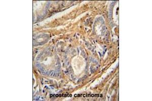 PCOTH antibody immunohistochemistry analysis in formalin fixed and paraffin embedded human prostate carcinoma followed by peroxidase conjugation of the secondary antibody and DAB staining.