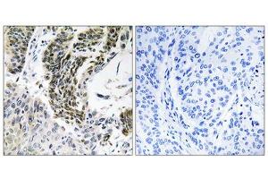Immunohistochemistry analysis of paraffin-embedded human lung carcinoma tissue using RREB1 antibody. (RREB1 Antikörper  (Internal Region))