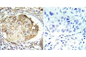 Immunohistochemical analysis of paraffin-embedded human breast carcinoma tissue using ERK1/2 (phospho- Thr202/Tyr204) (E012017). (ERK1/2 Antikörper  (pThr202, pTyr204))