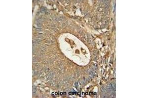 ACOX1 Monoclonal Antibody (ABIN659022 and ABIN2838046) immunohistochemistry analysis in formalin fixed and paraffin embedded human colon carcinoma followed by peroxidase conjμgation of the secondary antibody and DAB staining. (ACOX1 Antikörper)