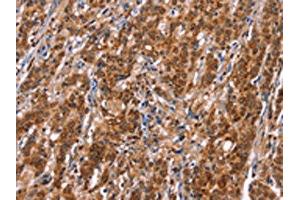 The image on the left is immunohistochemistry of paraffin-embedded Human gastic cancer tissue using ABIN7192753(TDP2 Antibody) at dilution 1/40, on the right is treated with synthetic peptide. (TDP2 Antikörper)