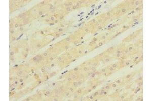 Immunohistochemistry of paraffin-embedded human gastric cancer using ABIN7143005 at dilution of 1:100