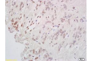 Formalin-fixed and paraffin embedded human cervial carcinoma labeled with Anti-CREB-1 Polyclonal Antibody, Unconjugated (ABIN723965) at 1:200 followed by conjugation to the secondary antibody and DAB staining. (CREB1 Antikörper  (AA 101-150))