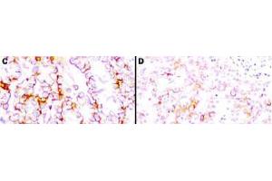Immunohistochemistry (IHC) image for anti-Mesothelin (MSLN) (Extracellular Domain) antibody (ABIN400815) (Mesothelin Antikörper  (Extracellular Domain))
