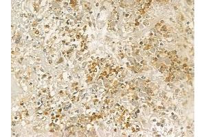 ABIN6261054 and ABIN6277031 at 1/100 staining human prostate carcinoma by IHC-P.