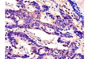 Immunohistochemistry of paraffin-embedded human colon cancer using ABIN7168925 at dilution of 1:100
