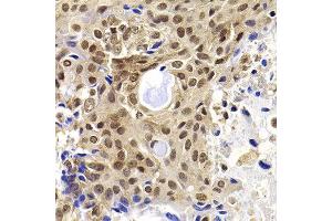 Immunohistochemistry of paraffin-embedded human oophoroma using PHF19 antibody at dilution of 1:100 (x40 lens). (PHF19 Antikörper)