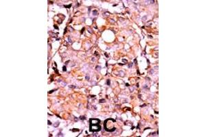 Formalin-fixed and paraffin-embedded human cancer tissue reacted with RAD9A (phospho S387) polyclonal antibody  which was peroxidase-conjugated to the secondary antibody followed by AEC staining.
