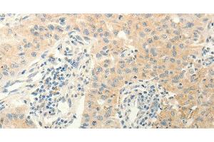 Immunohistochemistry of paraffin-embedded Human lung cancer using ERG Polyclonal Antibody at dilution of 1:40 (ERG Antikörper)