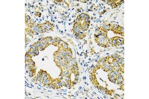 Immunohistochemistry of paraffin-embedded human gastric cancer using HSPA9 antibody. (HSPA9 Antikörper  (AA 380-679))