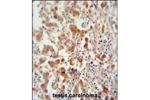 TEX13B antibody immunohistochemistry analysis in formalin fixed and paraffin embedded human testis carcinoma followed by peroxidase conjugation of the secondary antibody and DAB staining. (TEX13B Antikörper  (C-Term))