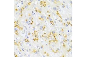 Immunohistochemistry of paraffin-embedded human liver cancer using FAS Antibody (ABIN5970062) at dilution of 1/100 (40x lens). (FAS Antikörper)