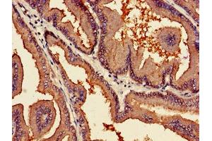 Immunohistochemistry of paraffin-embedded human prostate cancer using ABIN7163761 at dilution of 1:100 (PARN Antikörper  (AA 1-639))