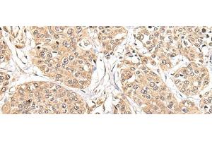 Immunohistochemistry of paraffin-embedded Human prost at e cancer tissue using ATL3 Polyclonal Antibody at dilution of 1:85(x200) (ATL3 Antikörper)