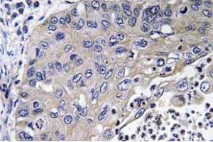 Immunohistochemistry (IHC) analyzes of Cathepsin D antibody in paraffin-embedded human lung carcinoma tissue. (Cathepsin D Antikörper)