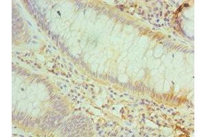 Immunohistochemistry of paraffin-embedded human colon cancer using ABIN7147161 at dilution of 1:100 (CD48 Antikörper  (AA 27-125))