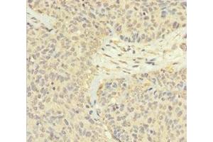 Immunohistochemistry of paraffin-embedded human ovarian cancer using ABIN7165526 at dilution of 1:100 (Protein FAM60A (SINHCAF) (AA 1-221) Antikörper)