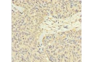 Immunohistochemistry of paraffin-embedded human ovarian cancer using ABIN7165526 at dilution of 1:100 (FAM60A Antikörper  (AA 1-221))