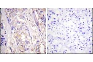 Immunohistochemistry analysis of paraffin-embedded human breast carcinoma tissue, using MEK1 (Ab-286) Antibody. (MEK1 Antikörper  (AA 252-301))