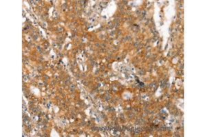 Immunohistochemistry of Human gastic cancer using MMP2 Polyclonal Antibody at dilution of 1:60 (MMP2 Antikörper)