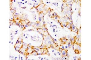 IHC-P: beta Catenin antibody testing of human breast cancer tissue (beta Catenin Antikörper  (AA 764-781))