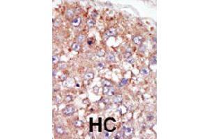 Formalin-fixed and paraffin-embedded human hepatocellular carcinoma tissue reacted with PTK6 polyclonal antibody  , which was peroxidase-conjugated to the secondary antibody, followed by AEC staining. (PTK6 Antikörper  (N-Term))
