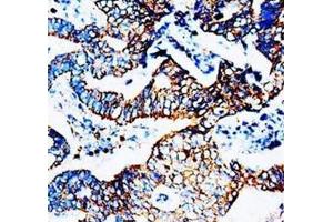 Immunohistochemical analysis of paraffin embedded rectal carcinoma sections, staining CCR5 in cytoplasm, DAB chromogenic reaction (CCR5 Antikörper  (N-Term))