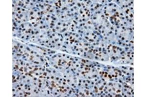 Immunohistochemical staining of paraffin-embedded Adenocarcinoma of colon tissue using anti-RC204952 mouse monoclonal antibody. (XRCC1 Antikörper)