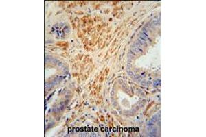 FSTL1 antibody immunohistochemistry analysis in formalin fixed and paraffin embedded human prostate carcinoma followed by peroxidase conjugation of the secondary antibody and DAB staining. (FSTL1 Antikörper  (C-Term))