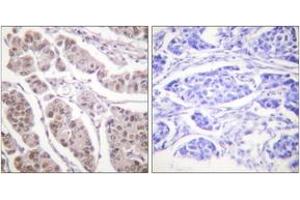 Immunohistochemistry analysis of paraffin-embedded human breast carcinoma tissue, using Histone H4 (Ab-5) Antibody. (Histone H4 Antikörper  (AA 1-50))