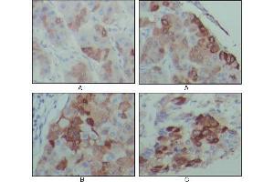 Immunohistochemical analysis of paraffin-embedded human hepatocarcinoma (A), breast carcinoma (B) and lung cancer tissues (C), showing cytoplasmic localization with DAB staining using PEG10 mouse mAb. (PEG10 Antikörper)