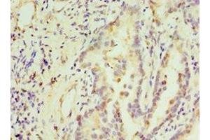 Immunohistochemistry of paraffin-embedded human lung cancer using ABIN7171228 at dilution of 1:100 (Syntaxin 16 Antikörper  (AA 1-300))